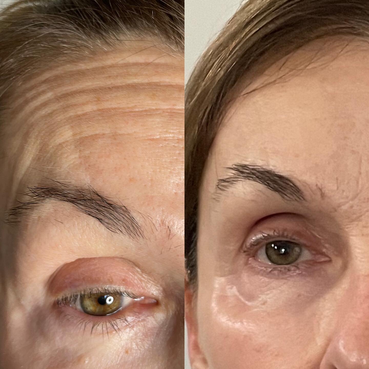 7 treatments and now we are taking a break to see what happens over the next couple of months. We hit some deep lines with a great outcome!
Contact me for more info and to schedule a free consult 💁🏼&zwj;♀️
✔TREATMENT IN 15 MINUTES
✔PAIN FREE
✔NO 