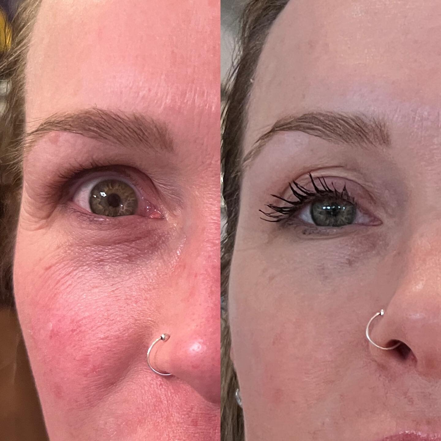 2 TREATMENTS DOES IN 3 DAYS‼️ Look at that 👁️ lift!!! The skin brightening with less redness &amp; the under eye brightness!! The softening of fine lines and all around tightening!!! 
✔TREATMENT IN 15 MINUTES
✔PAIN FREE
✔NO RECOVERY OR DOWNTIME
✔NO