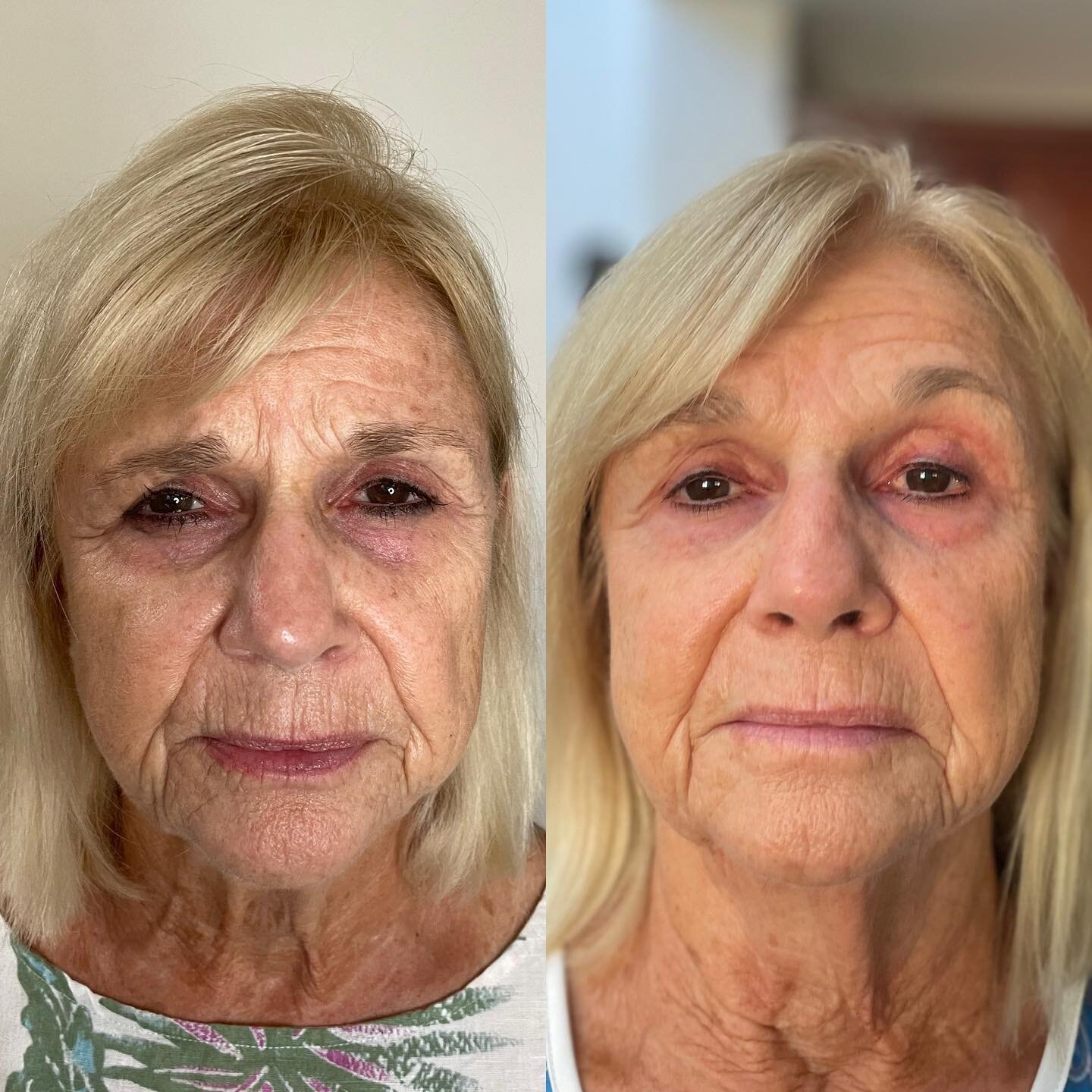 💁🏼&zwj;♀️ Well hello tighter and brighter ✨✨ 
We just finished 8 treatments over the course of 6 weeks. Now we are going to take a break and let the magic 🪄 happen. We focused on all over brightening and tightening of the neck. Notice the fading 
