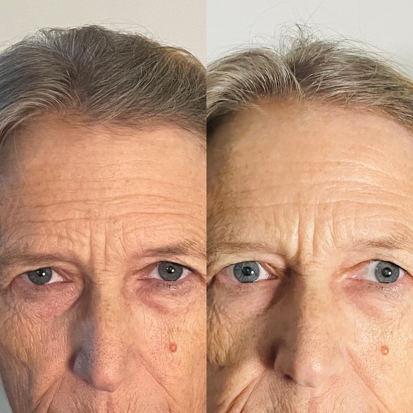 1 treatment!!! Look how awake those eyes are and the softening of the wrinkles! We will be doing a series of 8.  Stay tuned ✨✨✨ 
🚨remember this month all packages are 50% off and i now offer cherry payment plans 🍒🍒
#jetplasma #jetpenplasma #rest