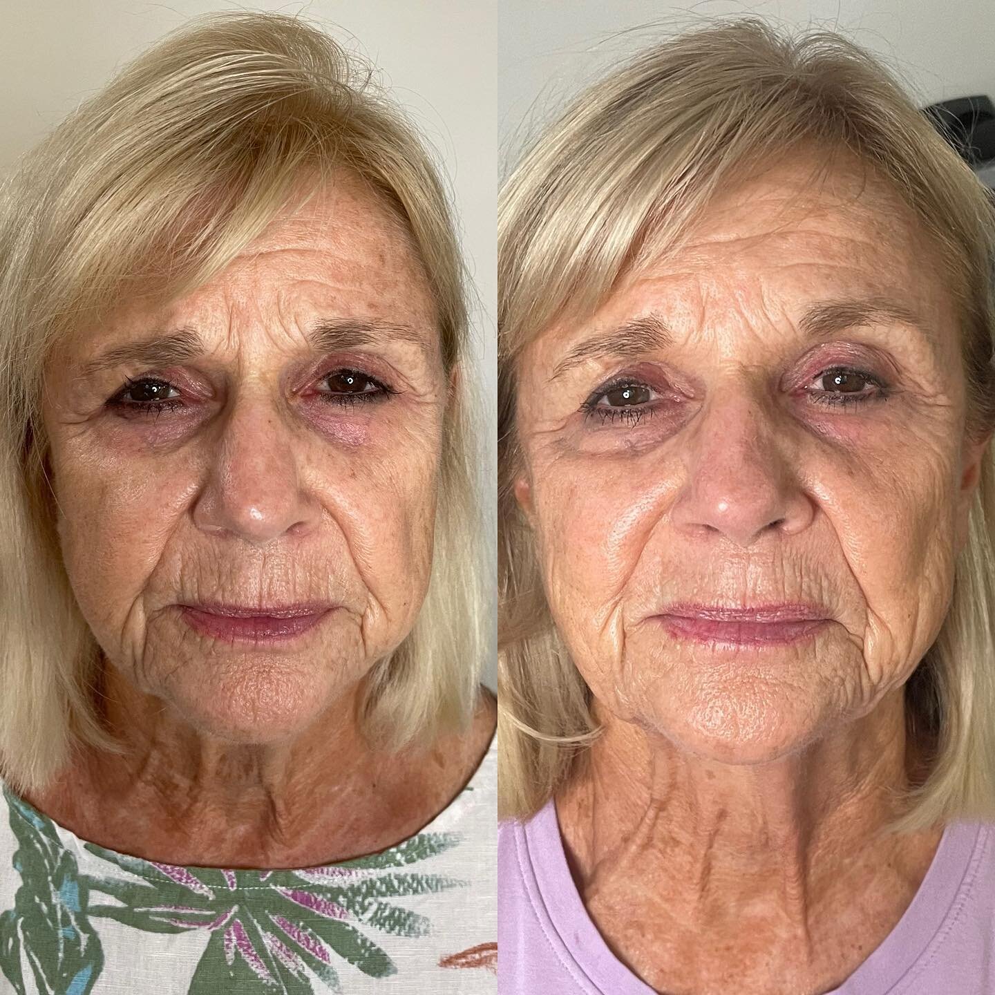 Slow &amp; steady wins the race🐢
We are 4 treatments in and the brightening and tightening is happening! Super happy where we are right now and 4 to go! 
Bye bye summer ☀️ spots and hello to fresh fall skin 🍁🧡 
Contact me to book or 🔗‼️
#jetp