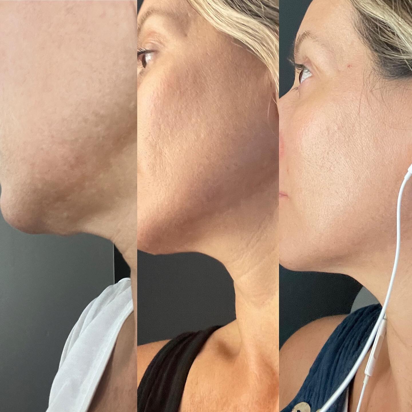 JET PLASMA WORKING SOME MAGIC 🪄 🪄 
Skin texture improved✅ 
Melasma improved✅
Neck tightened ✅
This list goes on and on!! DM or link to book ✨✨
#jetplasma #jetpenplasma #restoretheglow #skintightening #skinbrightening #proplasmaesthetic #magicwan