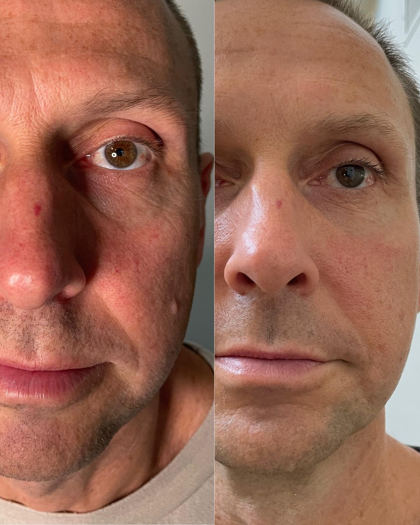 8 treatments done!!
Skin tighter ✅ brighter ✅ wrinkles are significantly diminished and smooth texture ✅ 
All of this with ZERO downtime, no numbing or pain!! 
Contact me for more details or link to my website 💁🏼&zwj;♀️
#jetplasma #jetpenplasma 