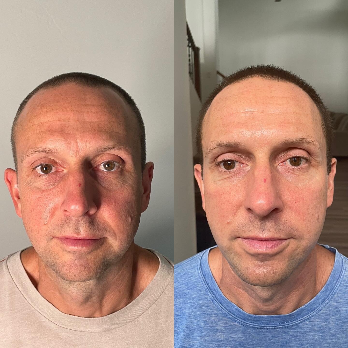 6 treatments in and we are working on all that sun exposure, texture, and tightening the skin!!! 
#jetplasma #jetpenplasma #restoretheglow #skintightening #skinbrightening #proplasmaesthetic #magicwand #gamechanger #instantresults #arizonasmallbusin