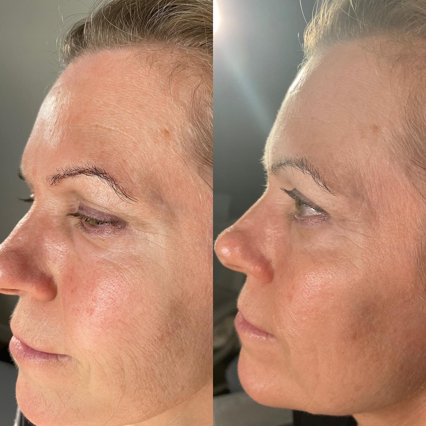 This is after ONE Treatment of the face and neck!!! ONE PEOPLE 💁🏼&zwj;♀️
20% off all month! 🔗 to book or DM for more info to ✨✨