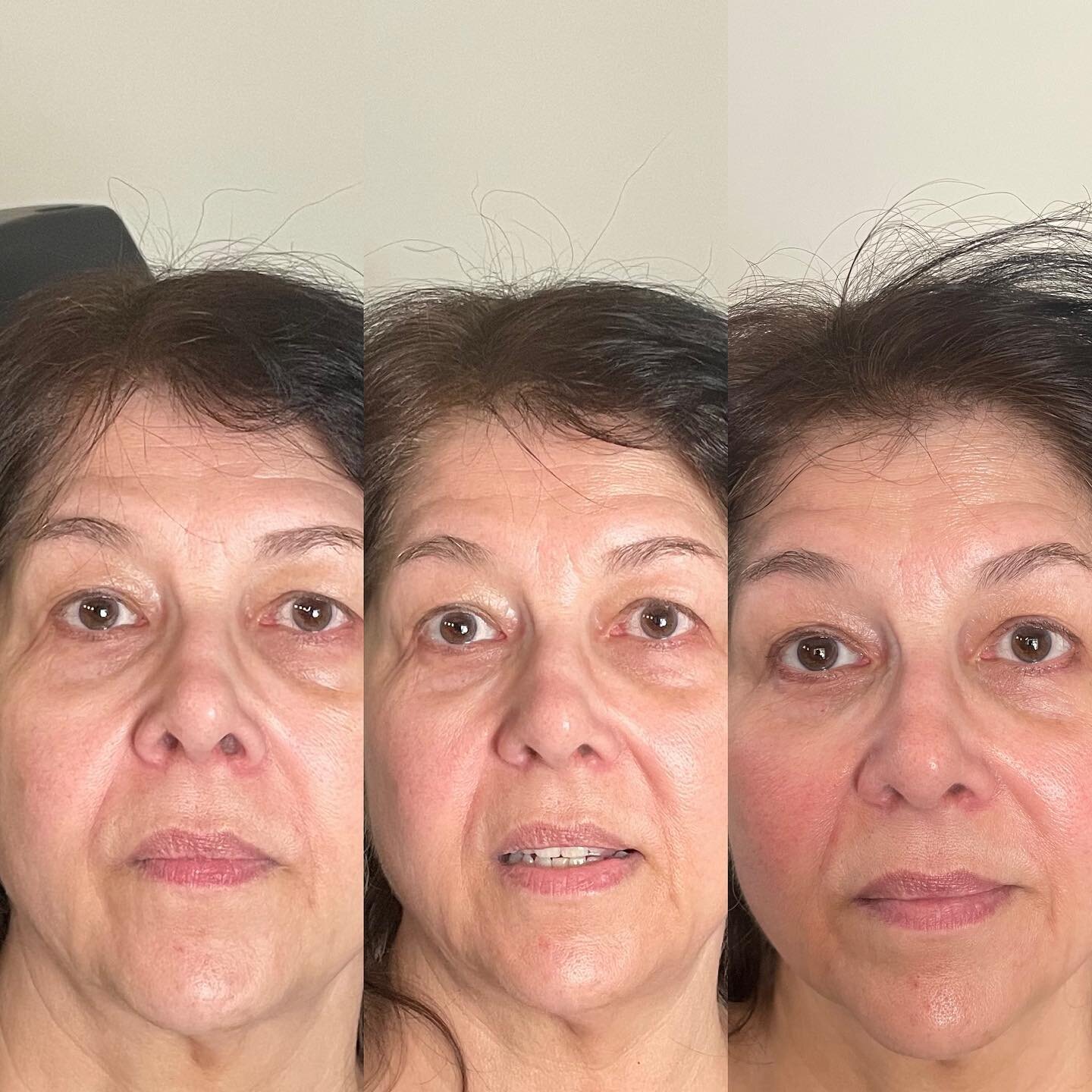 Ok ladies! 1st pic is before the first treatment, 2nd pic is immediately after the 1st and the 3rd pic is after the 2nd treatment‼️ ONLY 2 treatments!!
Focusing on the jowls and under eye bags and darkness. 
20% off all month!! 🔗in bio to book✨